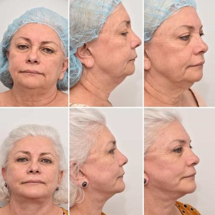 face-lift-rhytidectomy-miami-carlos-spera-25