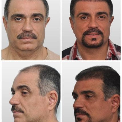 face-lift-rhytidectomy-miami-carlos-spera-3