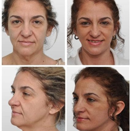face-lift-rhytidectomy-miami-carlos-spera-4