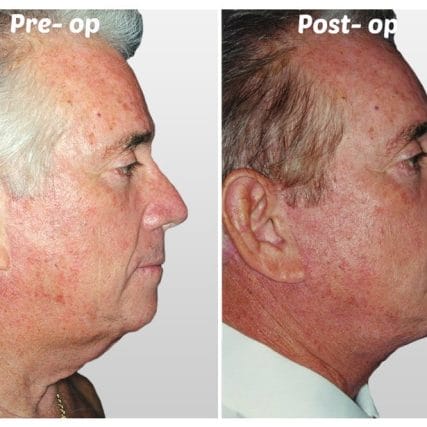 face-lift-rhytidectomy-miami-carlos-spera-5