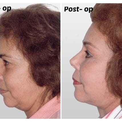 face-lift-rhytidectomy-miami-carlos-spera-6