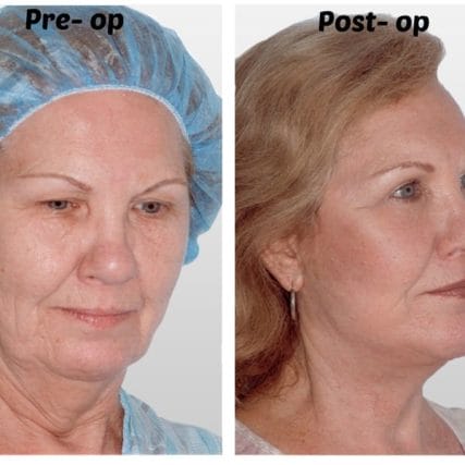 face-lift-rhytidectomy-miami-carlos-spera-7
