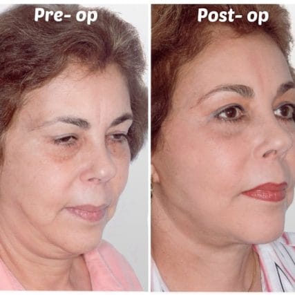 face-lift-rhytidectomy-miami-carlos-spera-8