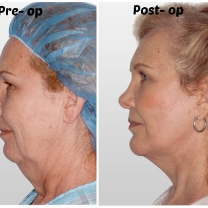 face-lift-rhytidectomy-miami-carlos-spera-9