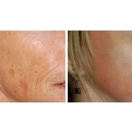 fractional-CO2-laser-skin-resurfacing-miami-carlos-spera-1
