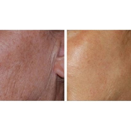 fractional-CO2-laser-skin-resurfacing-miami-carlos-spera-2