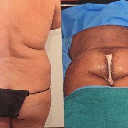 gluteoplasty-in-miami