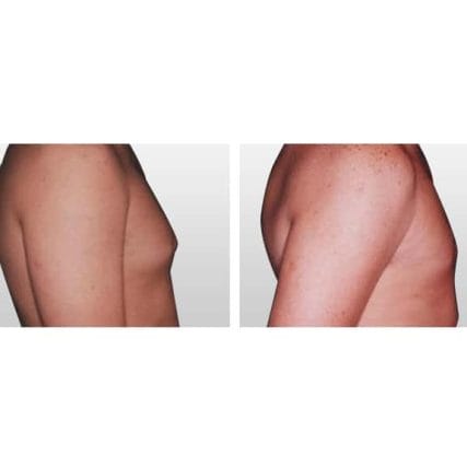 gynecomastia-male-breast-reduction-miami-carlos-spera-2