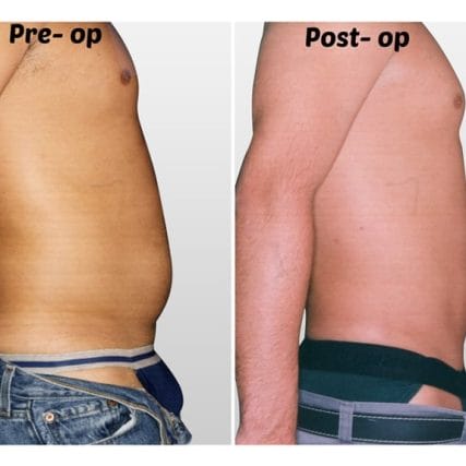 liposculpture-miami-carlos-spera-10