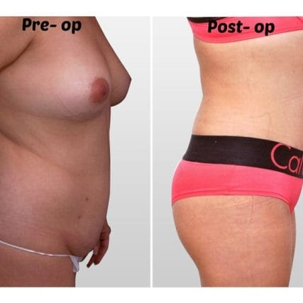 liposculpture-miami-carlos-spera-11