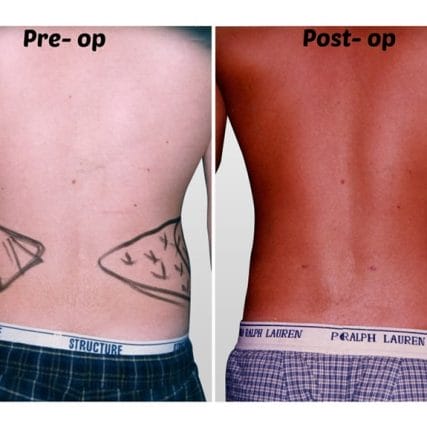 liposculpture-miami-carlos-spera-12