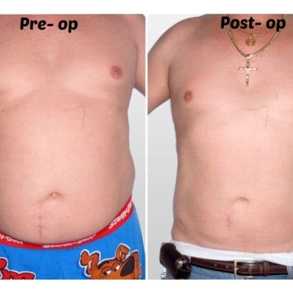 liposculpture-miami-carlos-spera-13