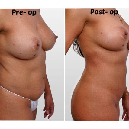 liposculpture-miami-carlos-spera-14