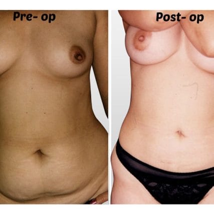 liposculpture-miami-carlos-spera-16