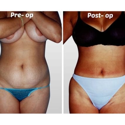 liposculpture-miami-carlos-spera-18