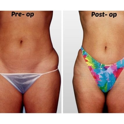 liposculpture-miami-carlos-spera-19