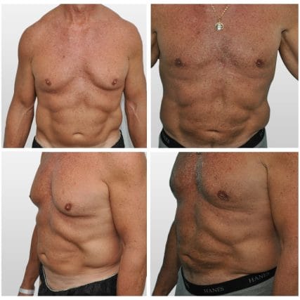 liposculpture-miami-carlos-spera-2