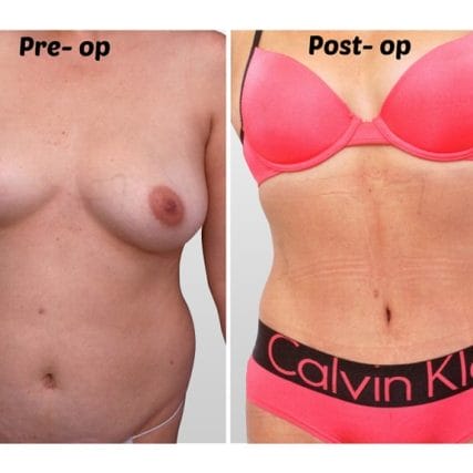 liposculpture-miami-carlos-spera-20