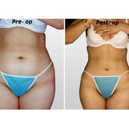 liposculpture-miami-carlos-spera-21