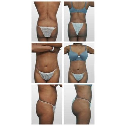 liposculpture-miami-carlos-spera-22