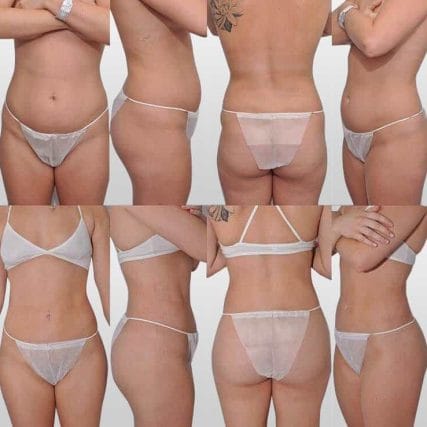 liposculpture-miami-carlos-spera-24