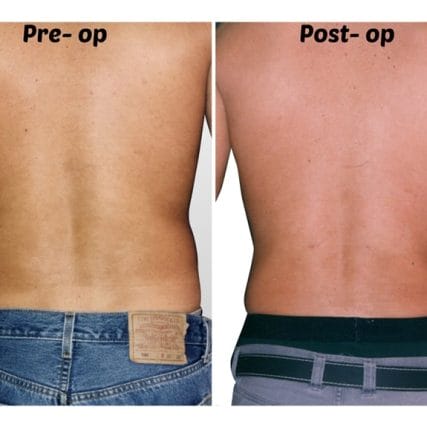 liposculpture-miami-carlos-spera-26