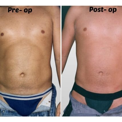 liposculpture-miami-carlos-spera-27