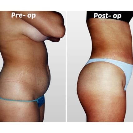 liposculpture-miami-carlos-spera-3