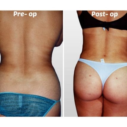 liposculpture-miami-carlos-spera-30