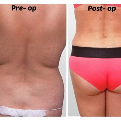 liposculpture-miami-carlos-spera-31