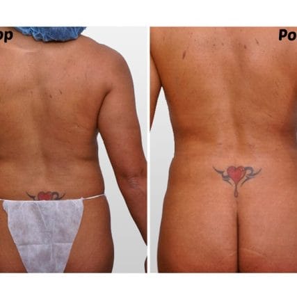 liposculpture-miami-carlos-spera-32