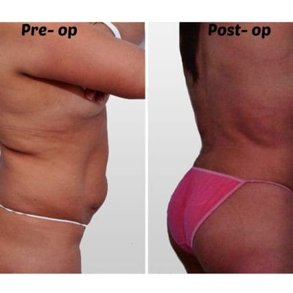 liposculpture-miami-carlos-spera-33