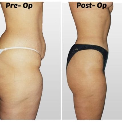 liposculpture-miami-carlos-spera-34