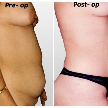 liposculpture-miami-carlos-spera-35