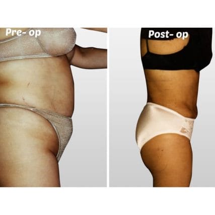 liposculpture-miami-carlos-spera-36