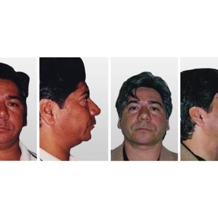 mentoplasty-chin-implants-miami-carlos-spera-2