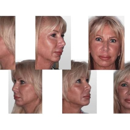 mentoplasty-chin-implants-miami-carlos-spera-3