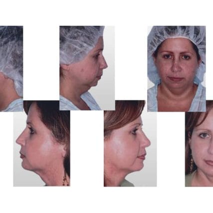 mentoplasty-chin-implants-miami-carlos-spera-4