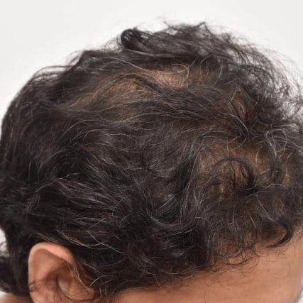 micro-hair-restoration-transplant-miami-carlos-spera-1