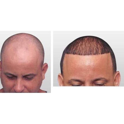 micro-hair-restoration-transplant-miami-carlos-spera-10