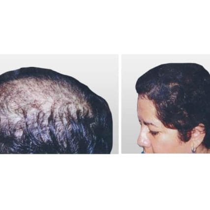 micro-hair-restoration-transplant-miami-carlos-spera-11