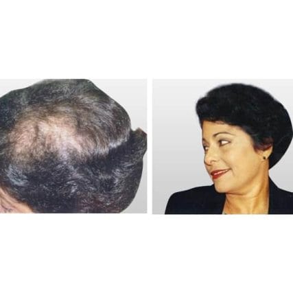 micro-hair-restoration-transplant-miami-carlos-spera-12