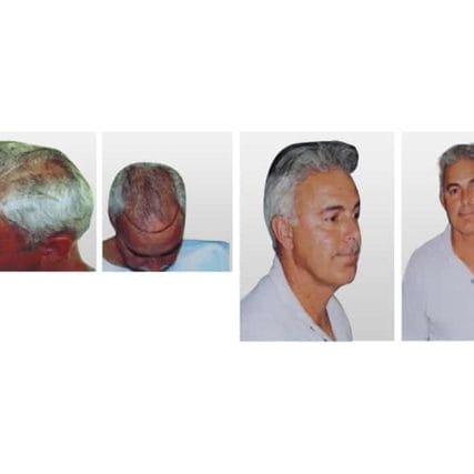 micro-hair-restoration-transplant-miami-carlos-spera-13