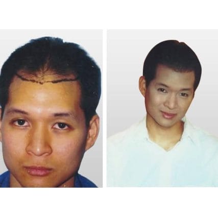 micro-hair-restoration-transplant-miami-carlos-spera-14