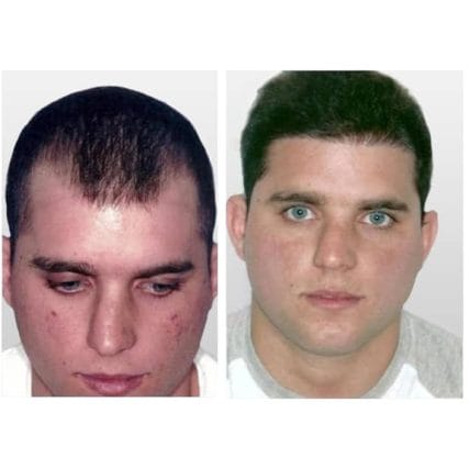 micro-hair-restoration-transplant-miami-carlos-spera-15