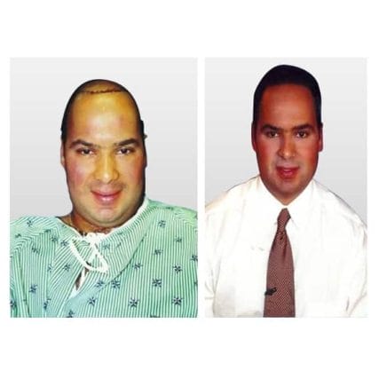 micro-hair-restoration-transplant-miami-carlos-spera-16