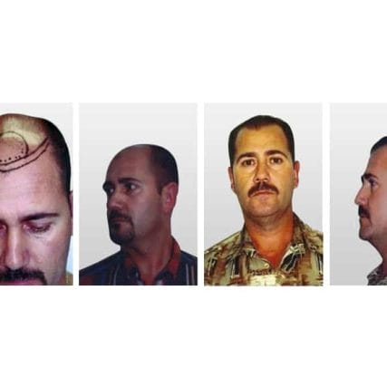 micro-hair-restoration-transplant-miami-carlos-spera-17