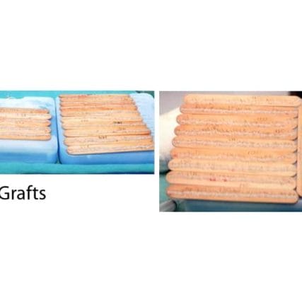 micro-hair-restoration-transplant-miami-carlos-spera-18