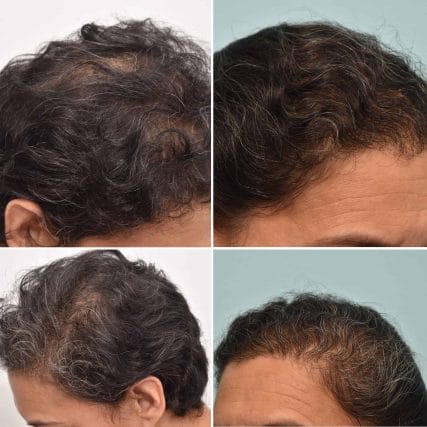 micro-hair-restoration-transplant-miami-carlos-spera-19