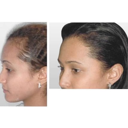 micro-hair-restoration-transplant-miami-carlos-spera-2